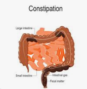 Image of Constipation