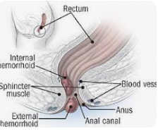 Image of Hemorrhoids
