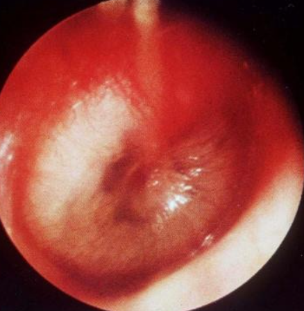 Image of a Middle Ear