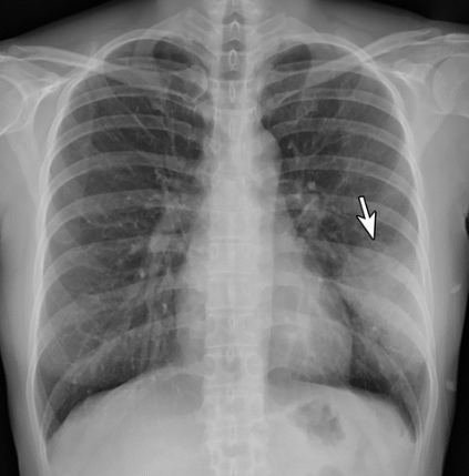 Image of Pneumonia