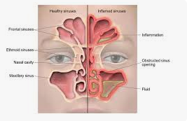 Image of a Sinus Infection