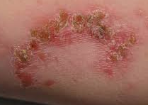 Image of a Mild Skin Infection