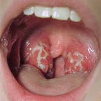 Image of a Strep Throat