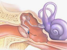 Image of a Tympanostomy